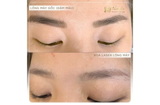 xoa-xam-long-may-bang-laser-gia-bao-nhieu (2)